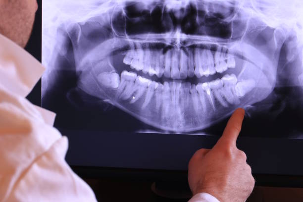 Best Knocked-Out Tooth (Avulsed Tooth) Treatment in Glen Rose, TX